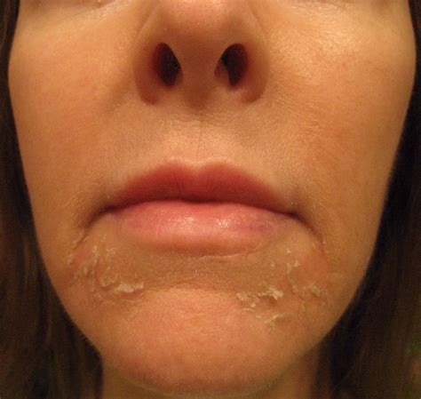 Chemical Peels For Acne And Anti Aging 4th Tca Peel Before And After