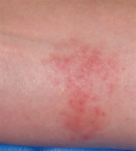 Allergic Contact Dermatitis Nickel