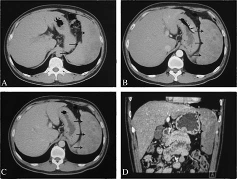 Contrast Enhanced Ct Scan Shows Heterogeneous Enhancement Of The Giant