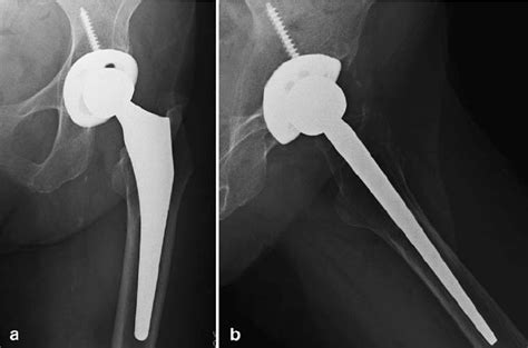 Accolade® Tmzf® Femoral Prosthesis Which Has A Tapered Wedge Fit