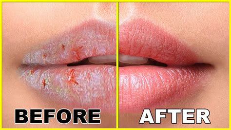 Easy Way To Protect Your Lips From Cold Diy Winter Dry Lips Youtube