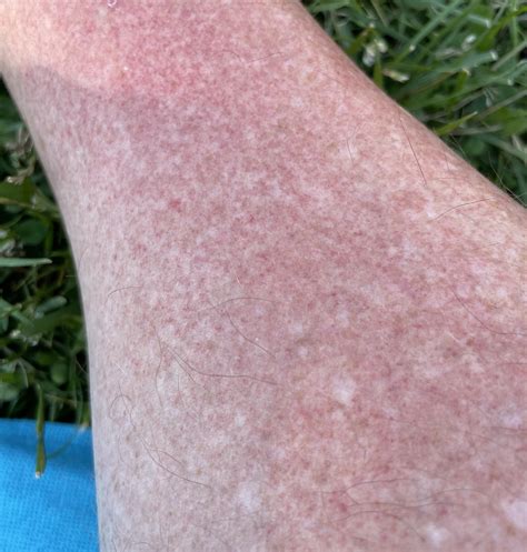 Sunburn On Legs Tiny Red Dots Rdermatologyquestions