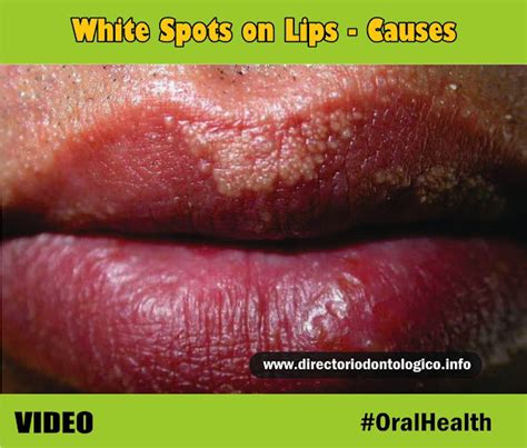 Oral Health White Spots On Lips Causes Directorio Odontológico