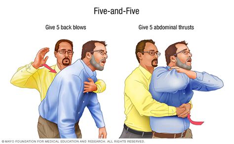 Choking First Aid Mayo Clinic Choking First Aid First Aid