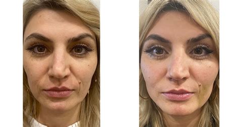 Thread Lift Before And After Photos The Plastic Surgery Clinic