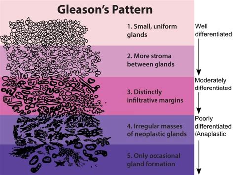 A Short Refresher Course On The Gleason Grade Group System Sperling