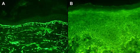 Direct Immunofluorescence Testing In The Diagnosis Of Immunobullous