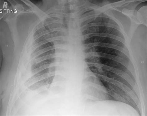 Tb Pleural Effusion