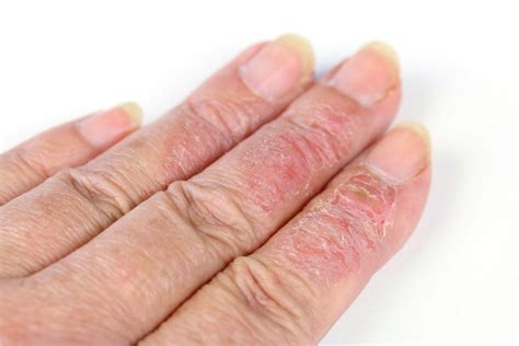 Can Eczema Affect Your Fingernails What You Need To Know Medovie Your Journey For Healthy