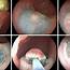 Hybrid Endoscopic Submucosal Dissection Appearance Of A 