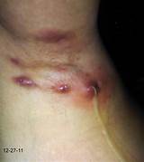 Treatment For Hidradenitis Suppurativa Armpit