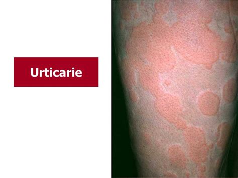 Ppt Urticaria Powerpoint Presentation Free Download Id6112505