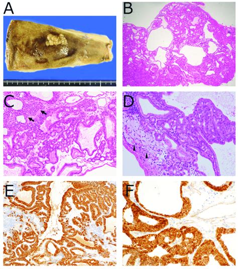 Pathology Of Pyloric Gland Adenoma Pga A Sessile Shaped Polyp Is
