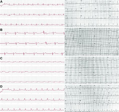 Apple Watch Series 4 Single Lead Electrocardiograms Left And 12 Lead