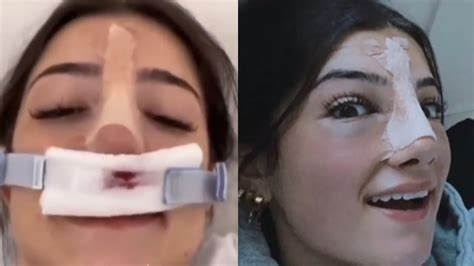 Charli D Amelio Nose Surgery Youtube