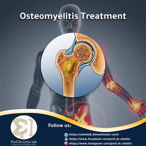 Treatment Of Osteomyelitis Dr What S Wrong With You
