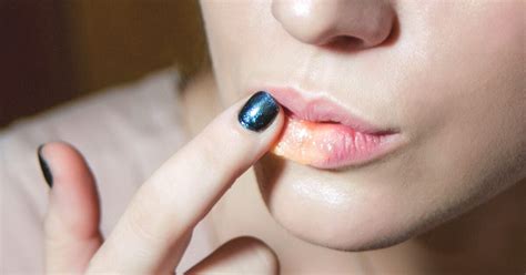 Split Lip Treatment Causes Vitamin Deficiency And Infection