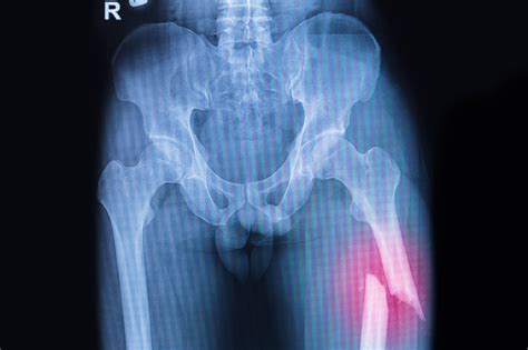 What Is A Femur Shaft Fracture Broken Thighbone Orthoindy Blog