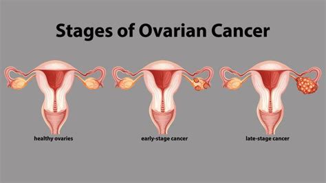 Part 1 How The Silent Killer Called Ovarian Cancer Develops Varnam My