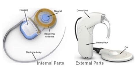 What Is A Cochlear Implant Understand The Functions Earguru