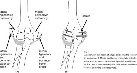 Figure 2 From The Effect Of Radial Head Excision And Arthroplasty On