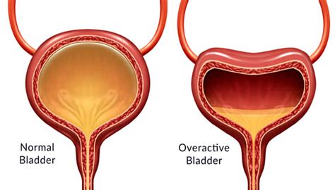 Overactive Bladder And Urinary Incontinence In Chembur Dr Swapnil Tople