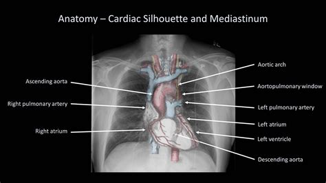 How To Interpret A Chest X Ray Lesson 2 A Systematic Method And