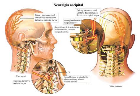 Neuralgia Occipital 750×516 Fibromyalgia Community