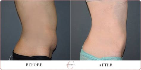 Female Tummy Liposuction Browse Before After Results