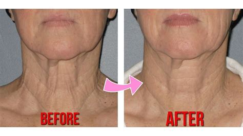 How To Permanently Remove Saggy Neck Wrinkles And Fine Lines With Anti