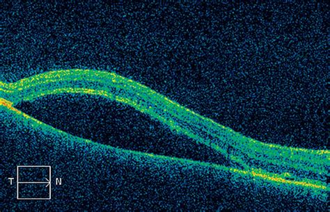 We did not find results for: Dalen Fuch's nodules and serous retinal detachment on ...