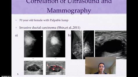 Mammography And Ultrasound In Screening And Diagnosis Of Breast Cancer