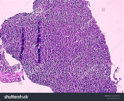 Tissue Right Axillary Lymph Node Histology Stock Photo 2140735627