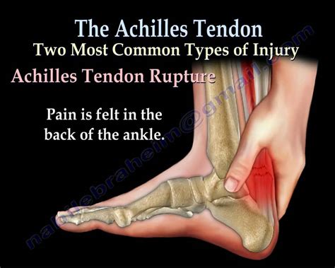 Torn Achilles Tendon Pictures The Meta Pictures