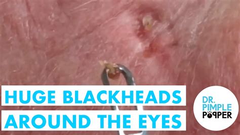 Huge Blackheads Around The Eyes Solar Comedones For Medical Education