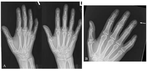 Figure 3 From Imaging Findings In Hypertrophic Osteoarthropathy A