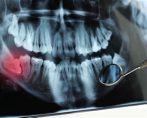 Wisdom Teeth Extraction Doncaster Doncaster Dental