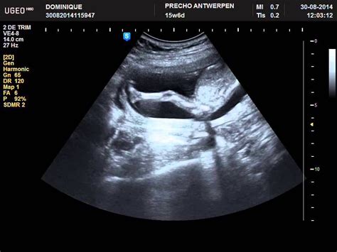 Pregnancy 15 Weeks Ultrasound Pregnancy Sympthom
