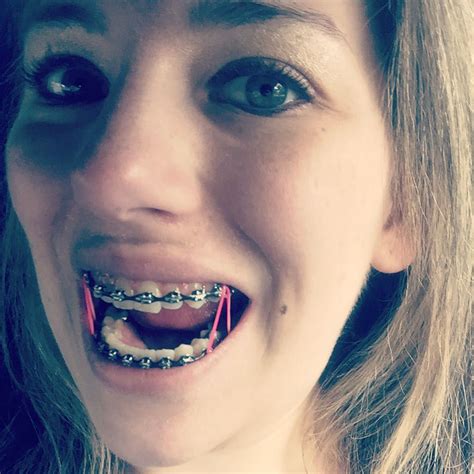 Braces Girlswithbraces Metalbraces Elastics Powerchain Dental
