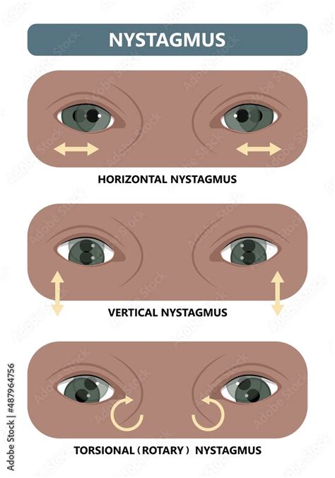 Miosis Eye Pupil Size Iris Retina Brain Horner Miotic Muscle Dilated