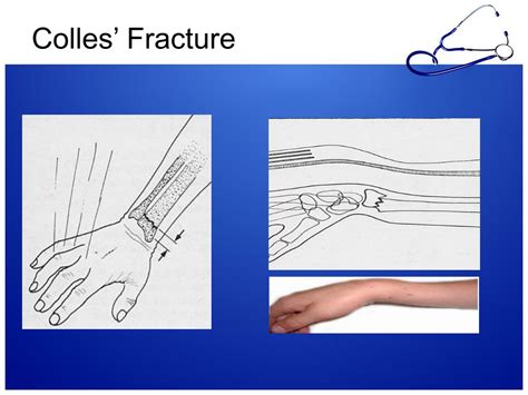 Ppt Hand Deformities Fractures And Palsy Powerpoint Presentation
