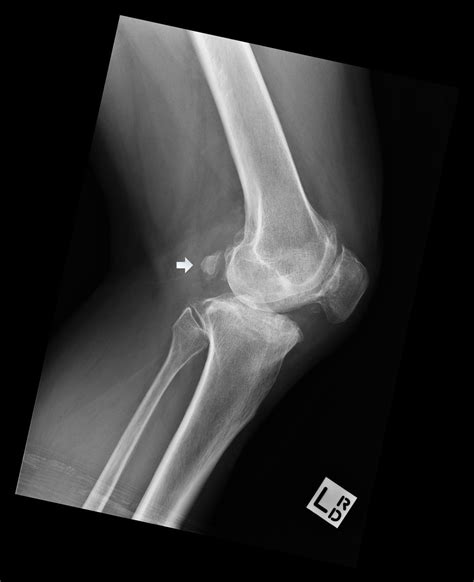 Lateral Knee X Rays