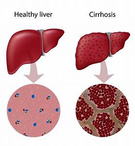 Cirrhosis of the Liver Podcast and Nursing Care Plan Cirrhosis  