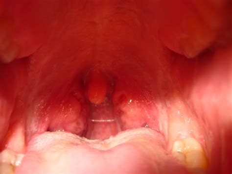 Swollen Tonsil On One Side Causes And Treatments New