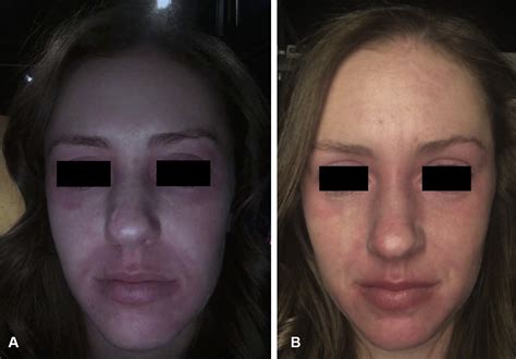 Alcohol Induced Facial Flushing In A Patient With Atopic Dermatitis