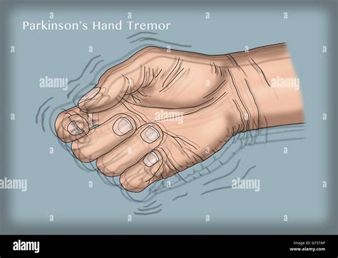Tremor Hand Reasons Why Your Hands Are Shaking Geelong Medical