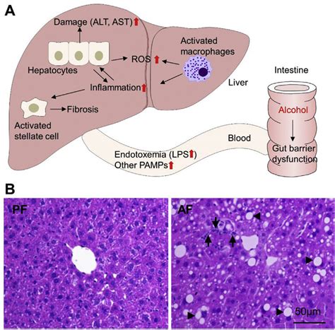 Gut Liver Axis In The Development Of Alcoholic Liver Disease A