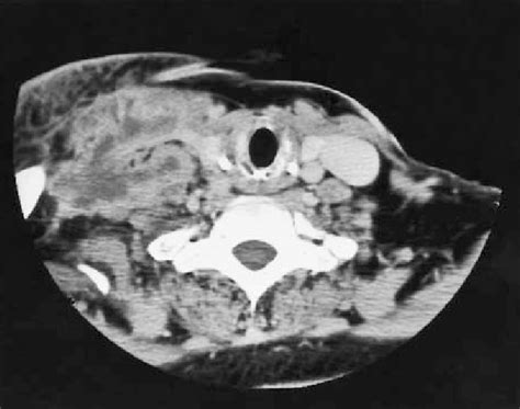 Ct Scan Showing Heterogeneous Mass Lesions With Irregular Walls In The