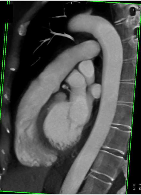Bicuspid Aortic Valve With Dilated Ascending Aorta Cardiac Case