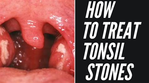 Tonsil Stone Removal 2021 Treatment And Prevention Youtube